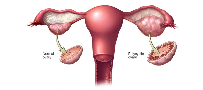 PCOD Treatment In Punawale